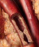 artery-plaque